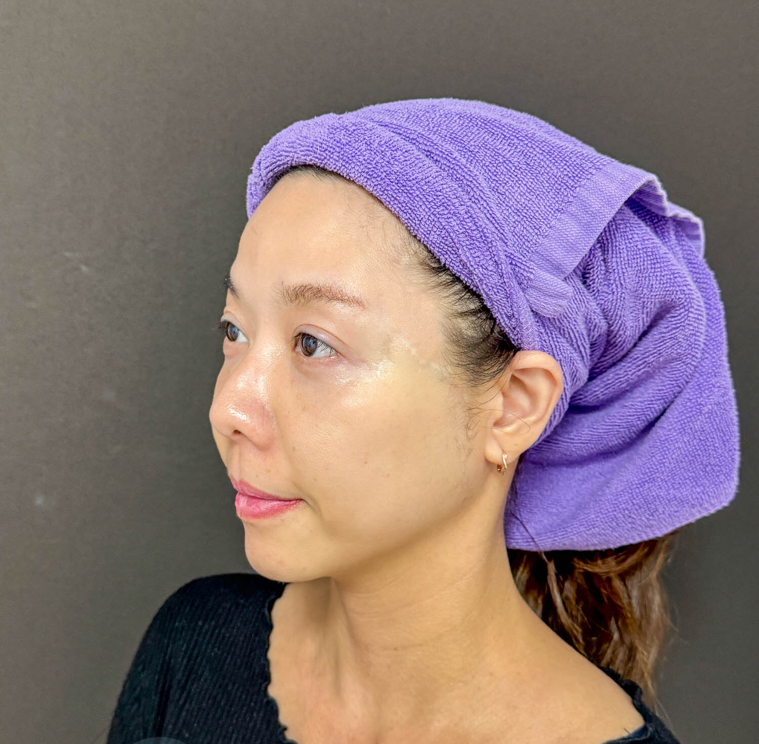 新北|愛爾麗診所(板橋店)》 Dual HI雙子極線音波 韓國黑科技,6倍能量拉提 雙線擊發高效率。 - 第8張圖 新北|愛爾麗診所(板橋店)》 Dual HI雙子極線音波 韓國黑科技,6倍能量拉提 雙線擊發高效率。