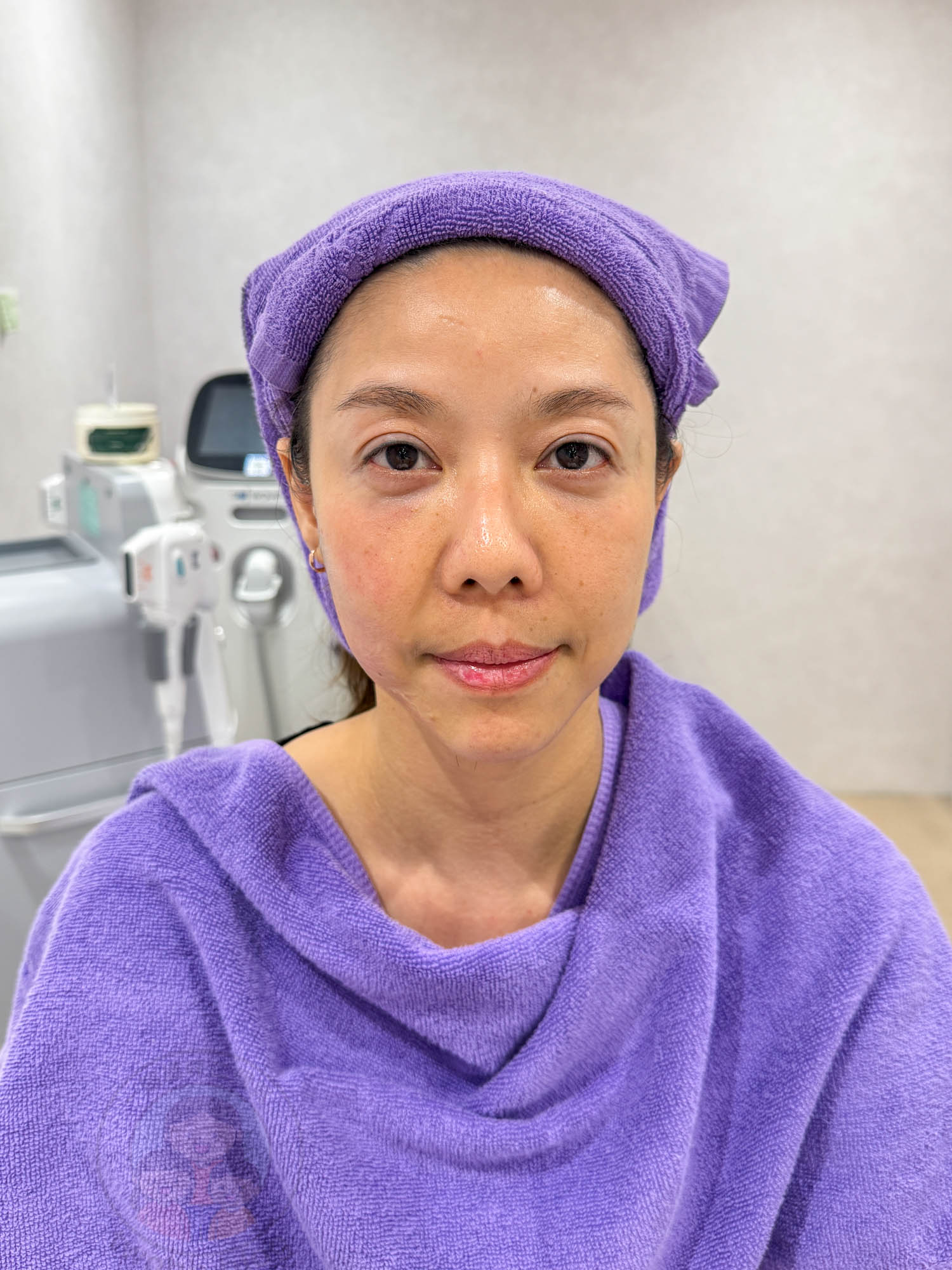 新北|愛爾麗診所(板橋店)》 Dual HI雙子極線音波 韓國黑科技,6倍能量拉提 雙線擊發高效率。 - 第17張圖 新北|愛爾麗診所(板橋店)》 Dual HI雙子極線音波 韓國黑科技,6倍能量拉提 雙線擊發高效率。