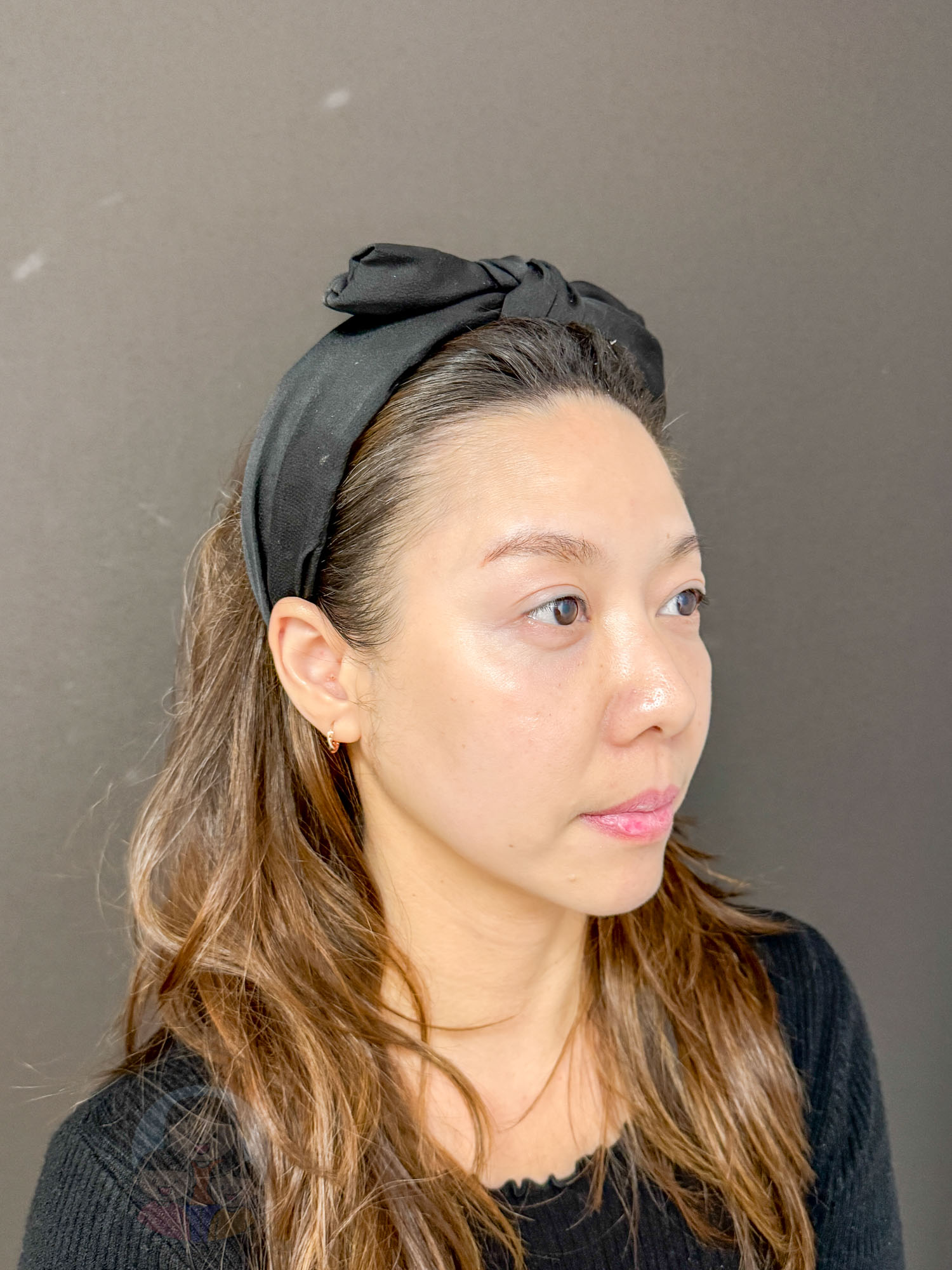 新北|愛爾麗診所(板橋店)》 Dual HI雙子極線音波 韓國黑科技,6倍能量拉提 雙線擊發高效率。 - 第19張圖 新北|愛爾麗診所(板橋店)》 Dual HI雙子極線音波 韓國黑科技,6倍能量拉提 雙線擊發高效率。